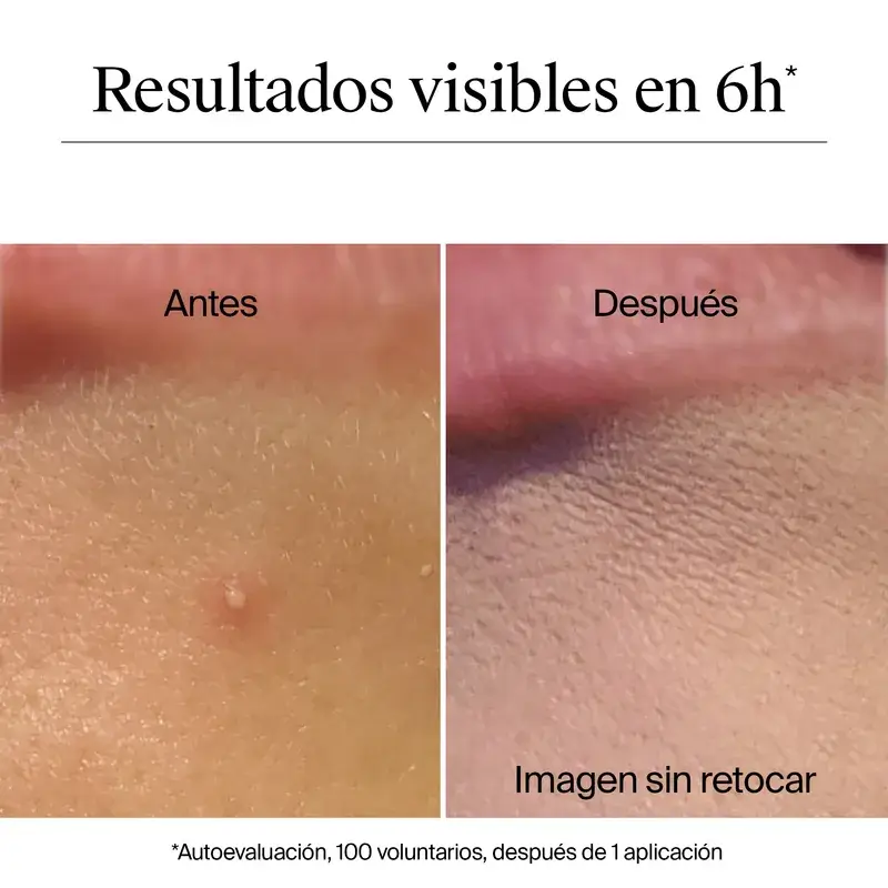 Neutrogena Clear & Defend+ Parches Granos Hidrocoloides Anti Acné 30 Uds - Image 5